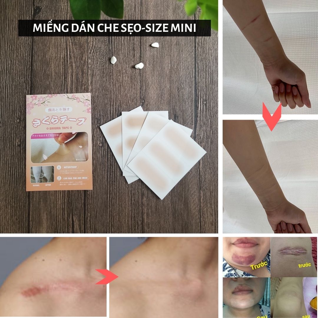 Miếng dán che sẹo Nhật Bản size 2,6x7cm che sẹo nhỏ sẹo lồi sẹo lâu năm chất liệu silicon cao cấp, siêu mỏng chống nước, chống mồ hôi, không dính bẩn quần áo