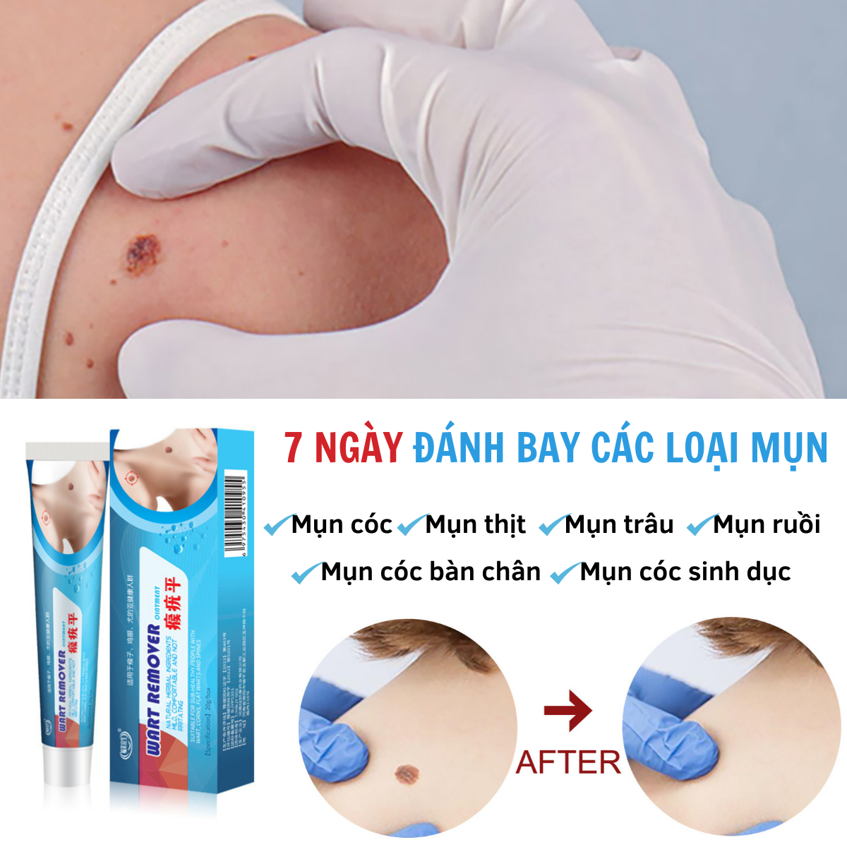 Gel tẩy nốt ruồi mụn thịt mục cóc an toàn hiệu quả nhanh chóng tẩy hết sạch nốt ruồi tàn nhan mụn cóc mụn thịt sẹo lồi trong vòng 3 ngày