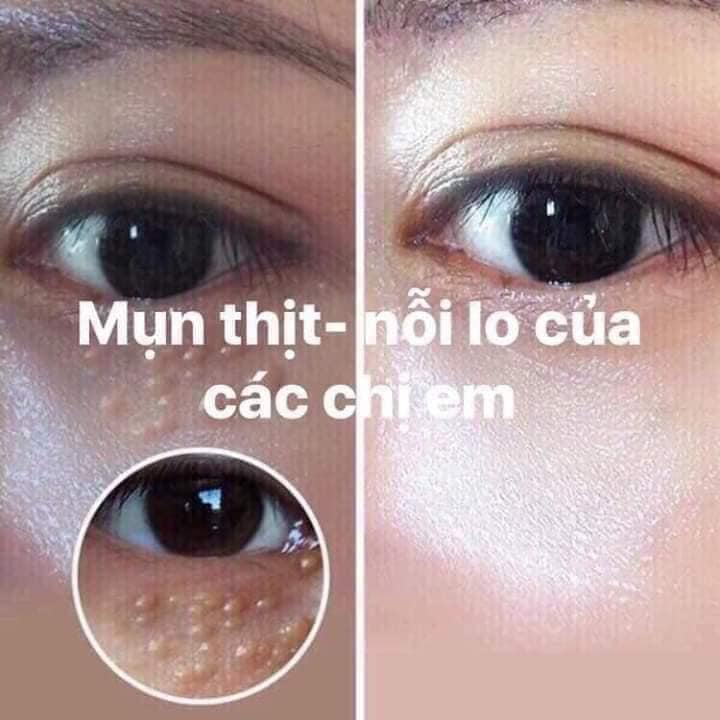 Triệt tận GỐC MỤN THỊT Quanh mắt- Kem mụn thịt quanh mắt, thâm quầng mắt lọ 40gr/ An toàn, hiệu quả/ thaoduocbaochau