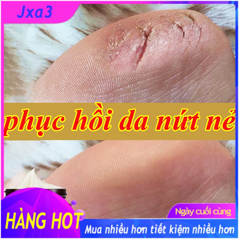 Kem phục hồi da chân tay Kem Dưỡng Ẩm 30g cải thiện thô ráp chiết xuất mỡ dầu phục hồi nứt nẻ và khô làm mạnh da