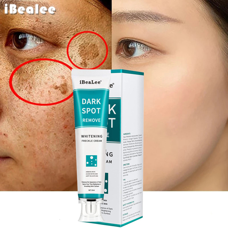 Kem Hết Nám, Tàn Nhang, Đồi Mồi iBeaLee Sau 1 Tuýp 20Ml