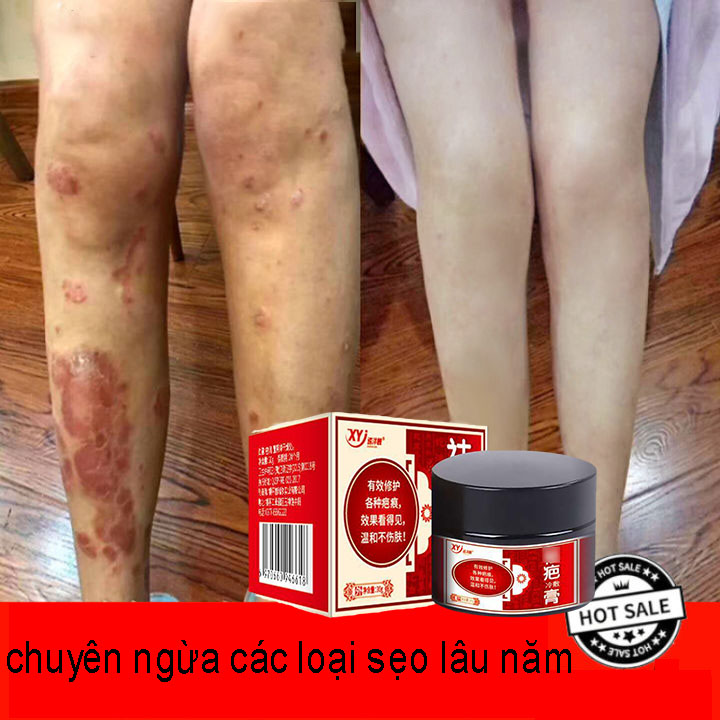 Kem xóa sẹo Chuyên xóa sẹo lồi mãn tính,Kem làm mờ sẹo làm trắng da Phục hồi sẹo Vết bỏng Làm mờ sẹo rỗ sẹo thâm, rạn da khi mang thai, Fraxel Loại bỏ sẹo mụn mụn trứng cá ngăn ngừa mụn .