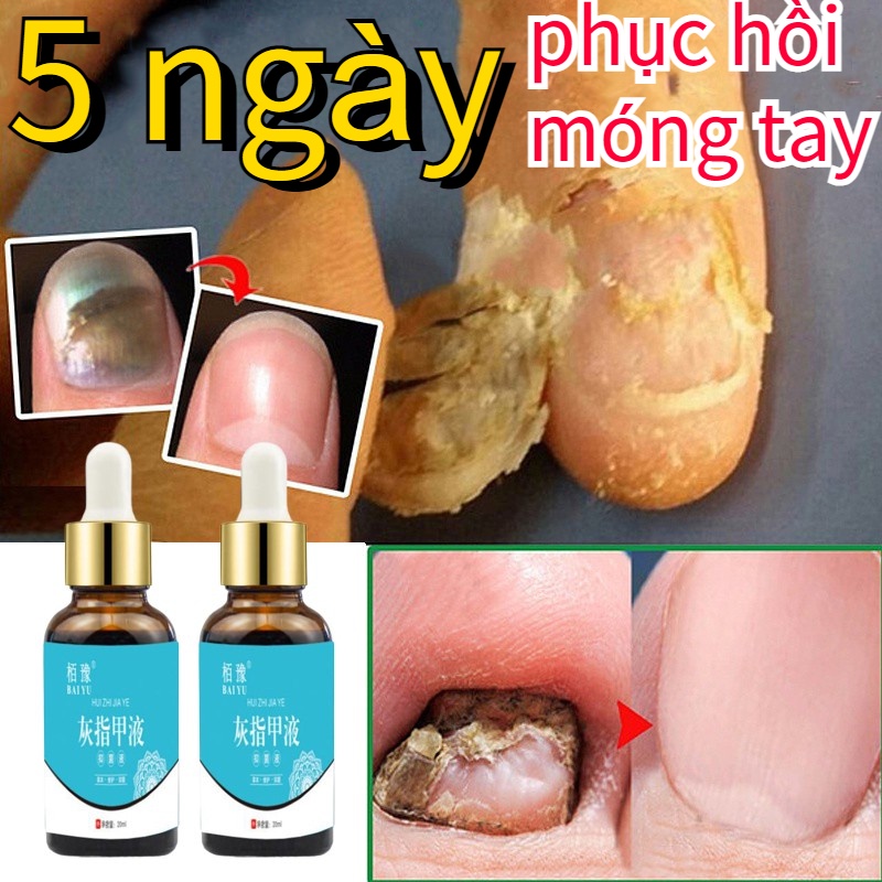 Dung dich nấm móng tay chân serum trị nấm móng tay móng chân Nhanh chóng loại bỏ nấm móng 20ml dung dịch kháng khuẩn dưỡng móng tay Gray nails