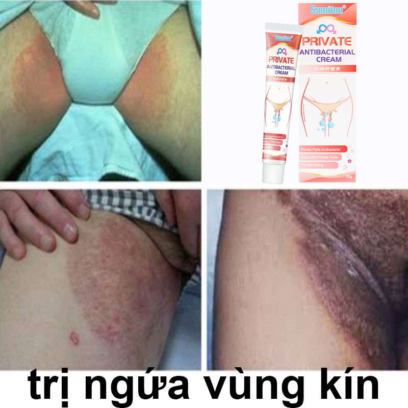 Kem bôi nấm ngứa bôi viêm da ngứa da chàm da á sừng kem bôi nấm thảo dược 20g chống ngứa nhanh chóng