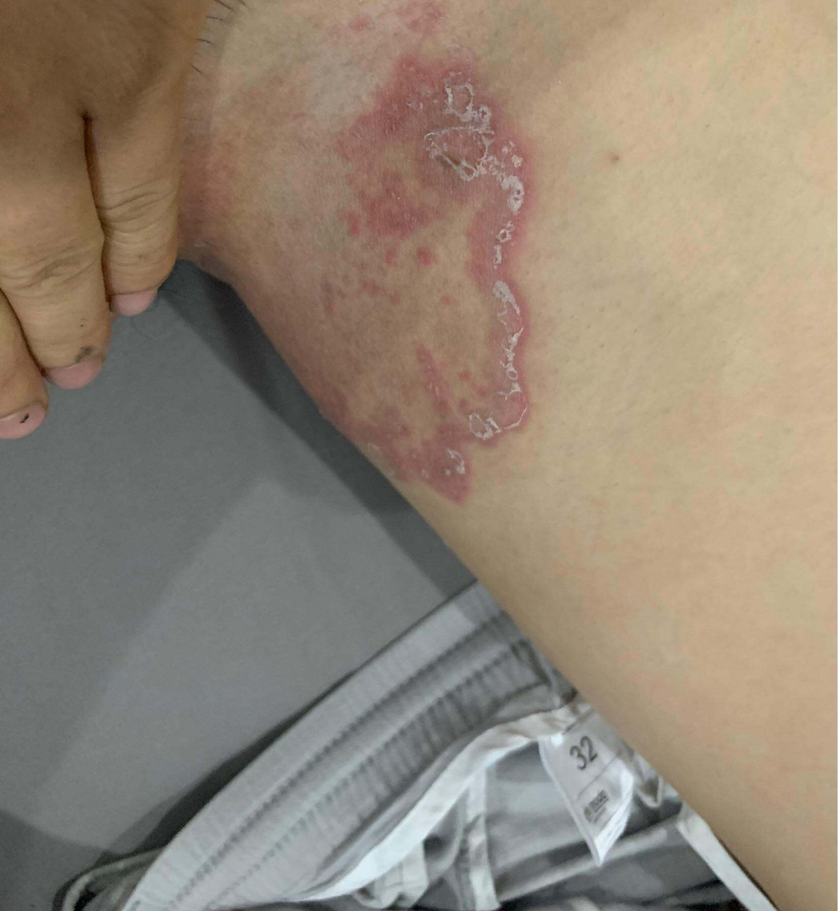 BÔi vùng kín Chàm Bẹn, Chàm Eczema, Hắc lào - Lác đồng tiền, Ghẻ Ngứa, Nấm Bẹn kem cải thiện Vấn Đề Da liễu