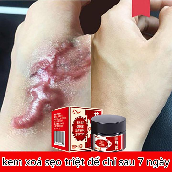 Kem che sẹo, chuyên xóa sẹo lồi lâu năm,sẹo bỏng,sẹo mụn,trầy xước.mờ sẹo thâm mụn,mờ thâm ,khổi phục da khổi phục da