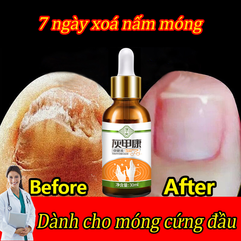 Tinh chất phục hồi diệt nấm móng phục hồi Loại bỏ nấm móng gãy dưỡng và kháng khuẩn cho móng tay giải quyết vấn đề viêm mé móng chân tay hiệu quả nhanh dùng cho nam và nữ Serum đánh bay nấm móng