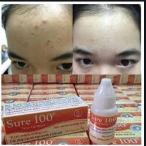 Kem giảm mụn ngăn ngừa vết thâm và giúp ngừa mụn tái phát  Sure 100
