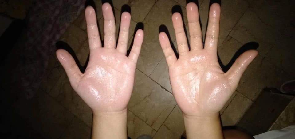 [HCM]Kem bôi hạn chế đổ mồ hôi tay chân Antihydral