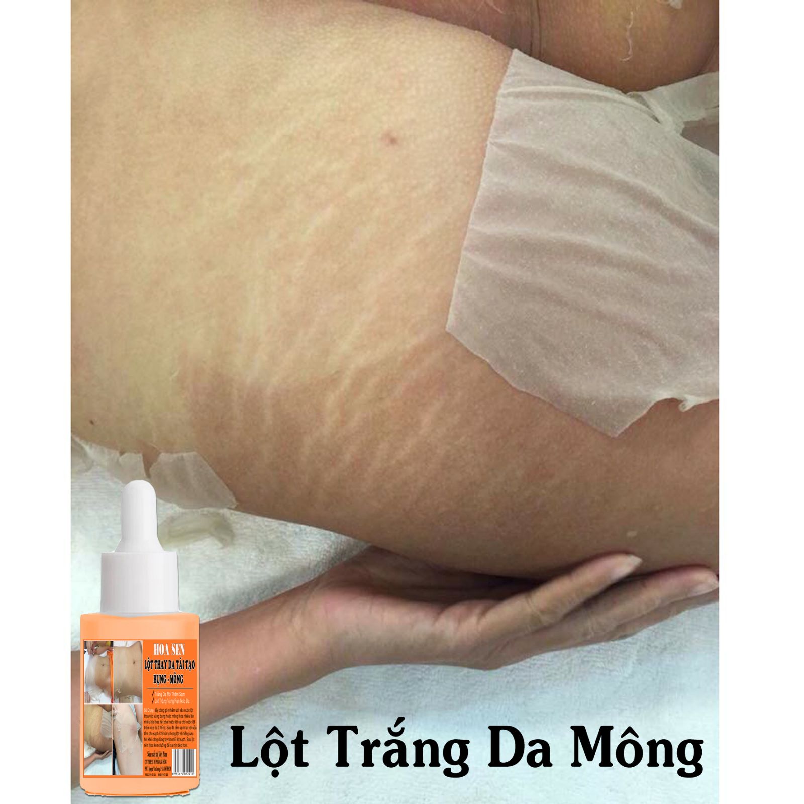 Tái tạo thay da bụng mông bẹn mờ rạn nứt hết thâm sạm