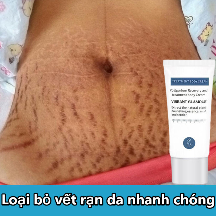 Kem xoá sẹo, xoá rạn da sau sinh, làm giảm vết rạn da do béo phì, kem làm mờ vết rạn da, làm mờ sẹo, dưỡng trắng 30g