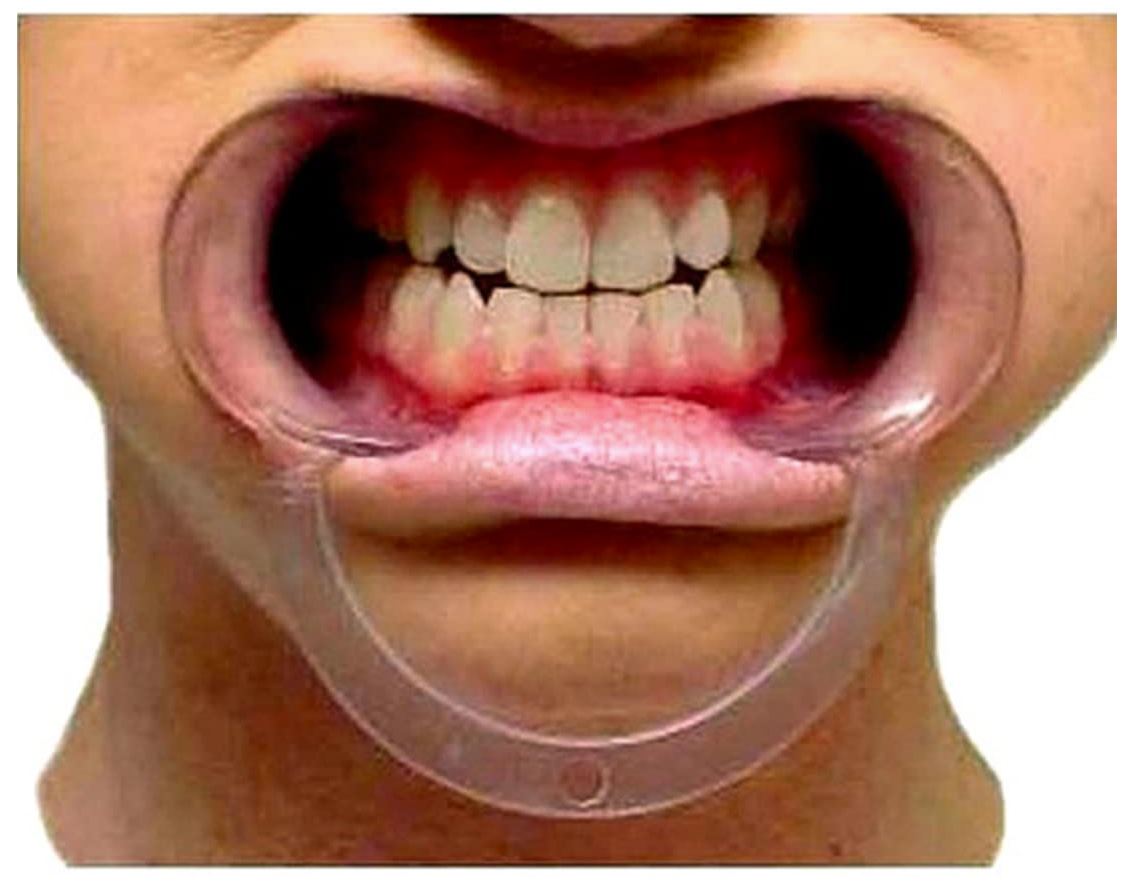 [HCM]3 dụng cụ banh Miệng Chữ C Dùng Cho Dụng Cụ Nha Khoa (3 cỡ)