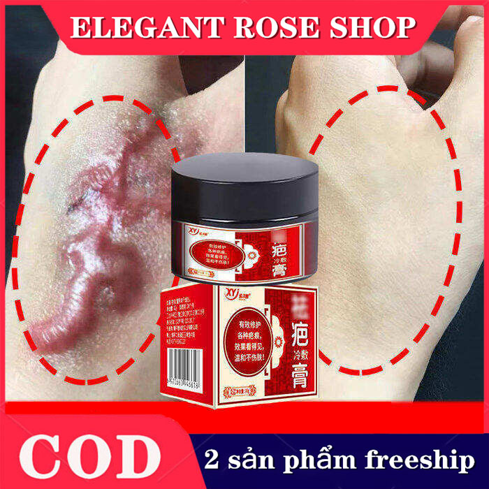 Kem chuyên làm mờ sẹo lâu năm,sẹo lồi lâu năm,Kem chuyên xóa sẹo lồi lâu nămsẹo bỏngsẹo mụntrầy xước.mờ sẹo thâm mụnmờ thâm khổi phục da,sửa chữa da làm sáng da, vết nhăn béo phì.