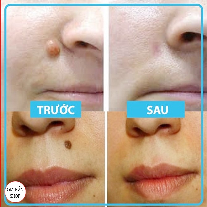 [HCM]Kem chấm xóa nốt ruồi tàn nhang mụn thịt nhanh LALA