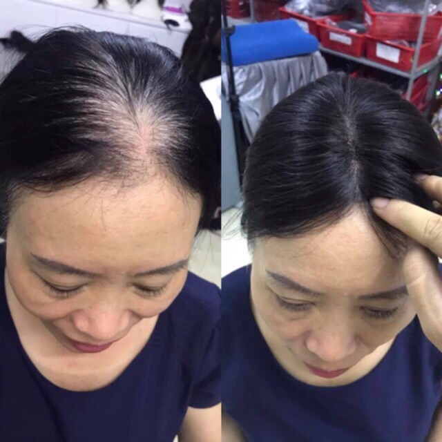 Tóc giả che mái hói 2 mái❤️tóc đỉnh đầu có da đầu- hình thật