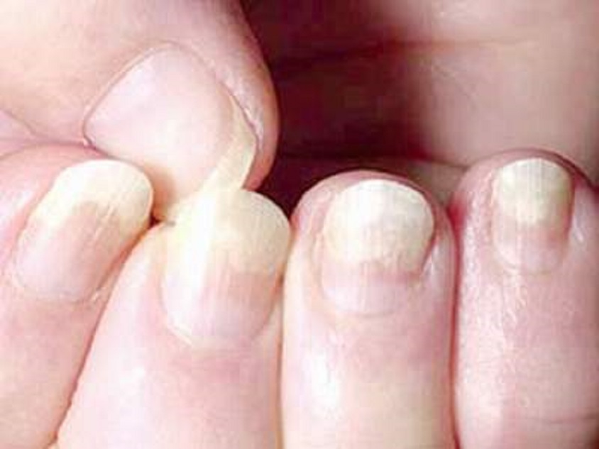 Emtrix dùng trong các trường hợp móng ố đen, vỡ đầu móng, móng và da không ăn khớp với nhau
