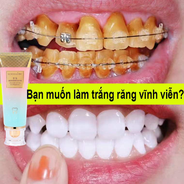（Làm trắng răng nhanh trong 3 ngày）Kem đánh răng làm trắng răng, loại bỏ cao răng để ngăn ngừa sâu răng, loại bỏ hơi thở hôi, làm sạch răng
