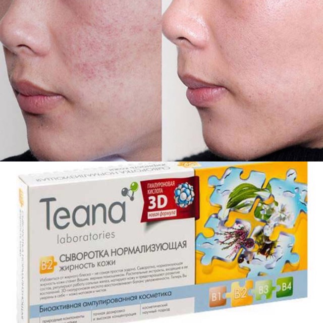 Collagen Teana B2 chống viêm, điều tiết lượng dầu