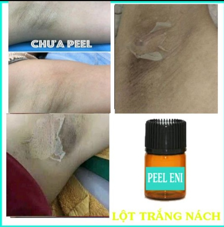 Peel lột trắng da nách. hết thâm