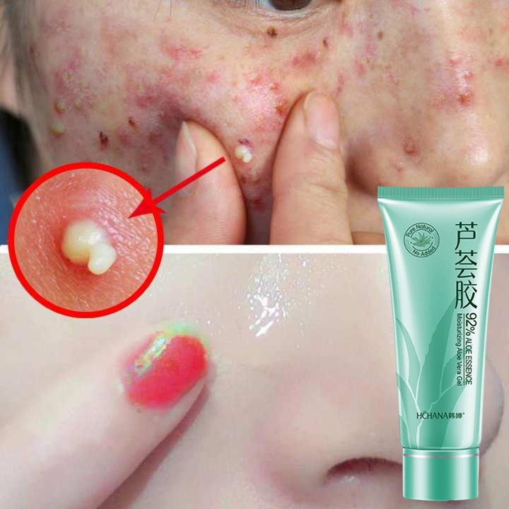 Gel lô hội dưỡng ẩm làm dịu mát da dưỡng ẩm 92% Tinh chất gel lô hội