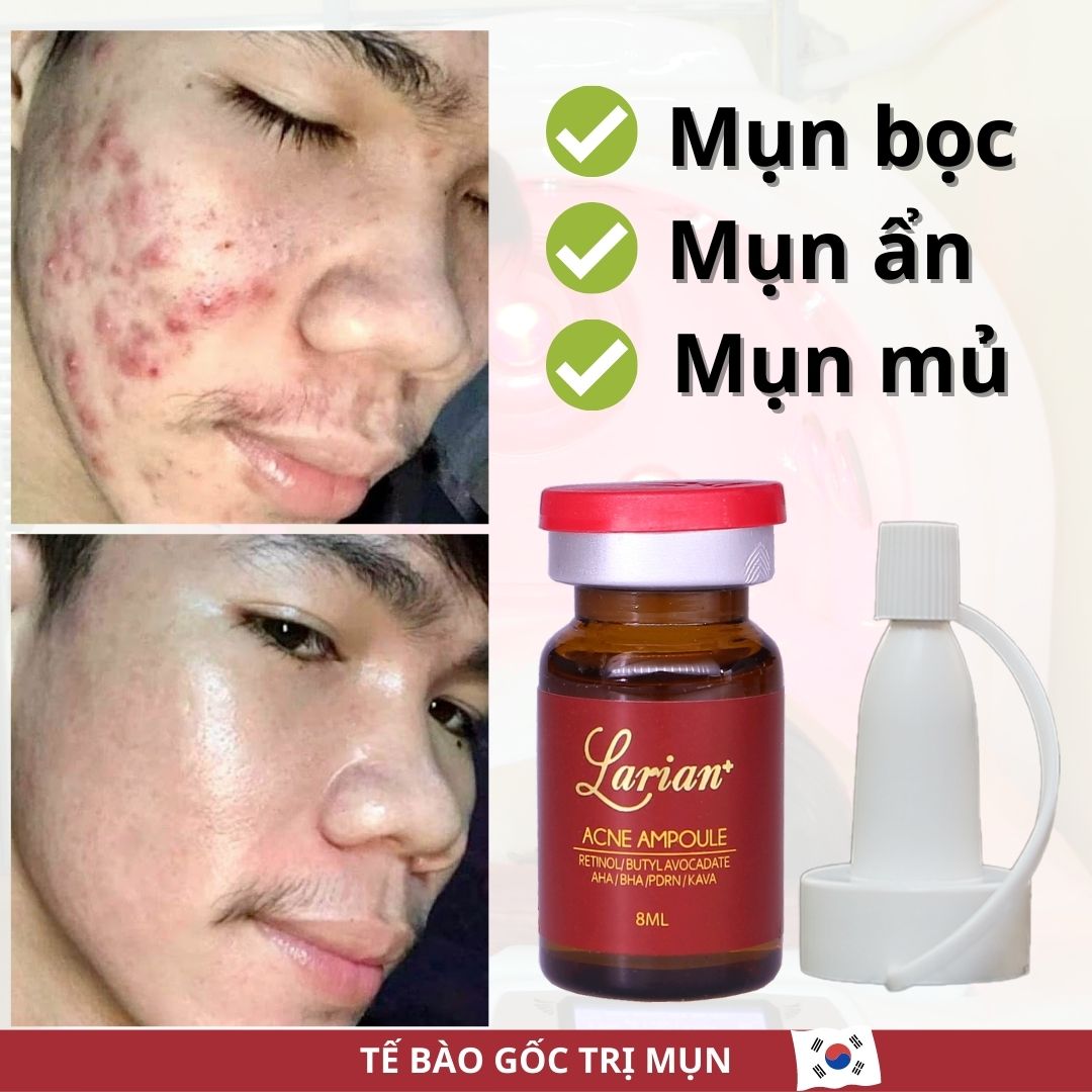 Serum trị mụn thâm - retinol/aha/bha dna cá hồi