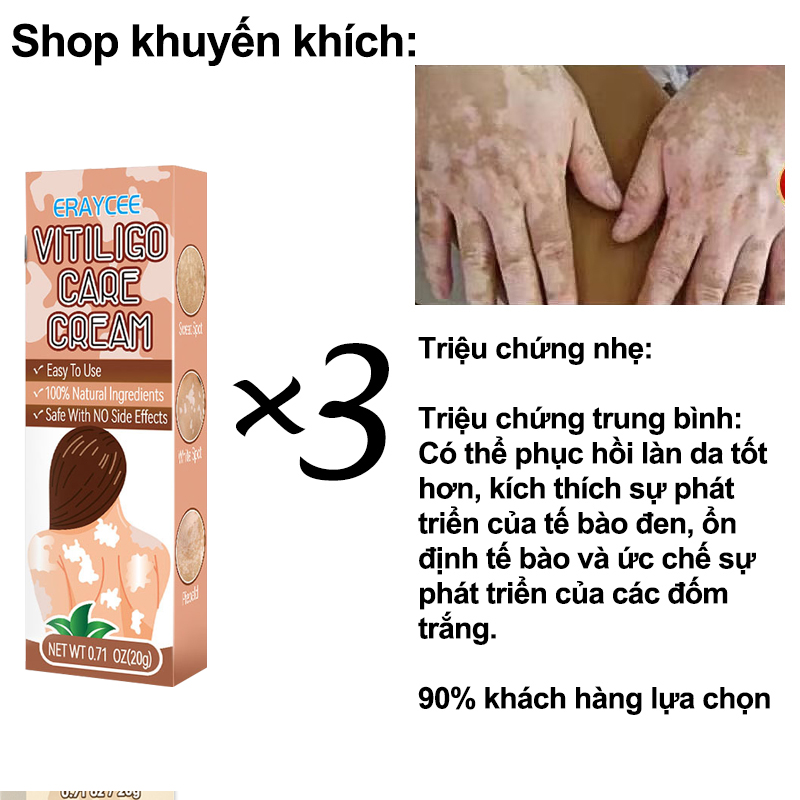 Kem Bôi Chống Khuẩn Lang Ben Hắc Lào Loại Bỏ Bạch Biến Lang Ben Dịu Nhẹ Không Kích Ứng Thúc Đẩy Tăng Trưởng Hắc Tố Tái Tạo Da 20G