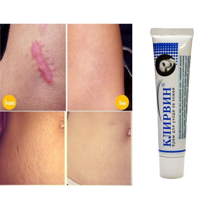 Gel Tẩy Nốt Ruồi Mụn Cơm Mụn Cóc tặng Gel liền Seo Nga An Toàn Hiệu Quả, gel liền sẹo Nga, hàng nhập khẩu chất lượng cao