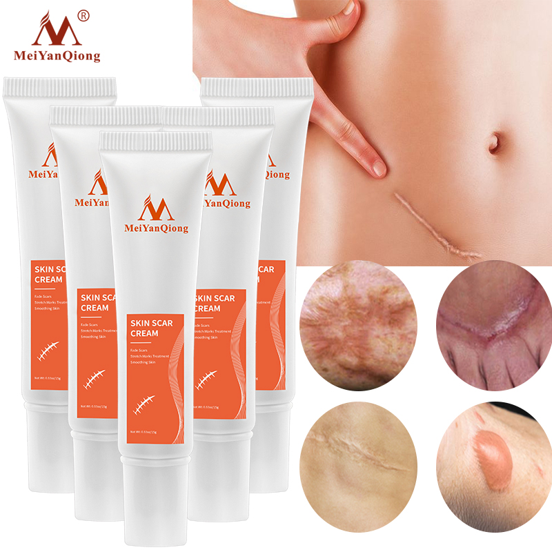 MeiYanQiong 5PCS Kem chữa rạn da, sẹo giúp đẩy nhanh quá trình tái tạo tế bào, làm mờ các vết thâm, sẹo do mụn