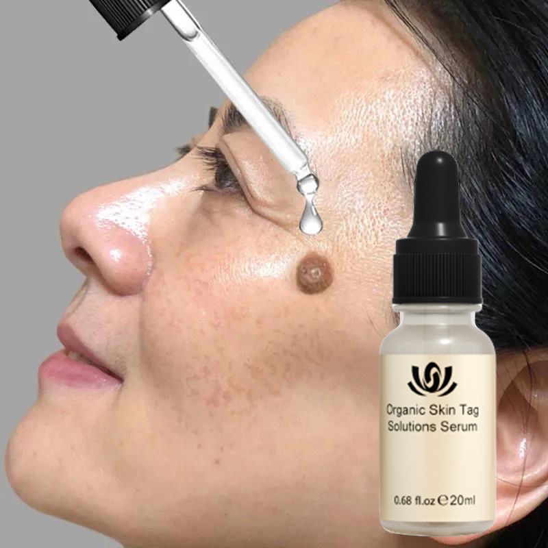 Kem tẩy nốt ruồi trị mụn cóc kem mụn cóc 7 ngày loại bỏ mụn cóc nhanh chóng Loại bỏ mụn cóc an toàn và không đau 20g