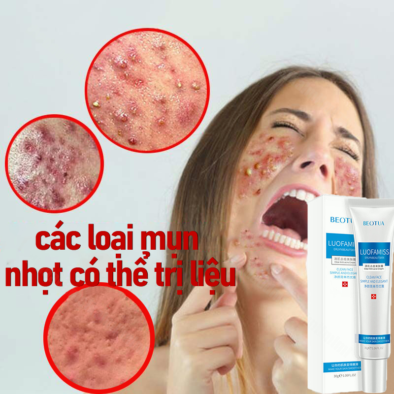 Kem xóa mụn kem xóa mụn nhanh chóng, kem xóa mụn,mụn trứng cá phục hồi và chống viêm mụn trứng cá, mụn sẫm màu