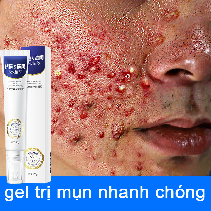 Kem thâm mụn Kem mụn Gel mụn 20g Nhanh chóng Hiệu quả loại bỏ mụn bọc Làm sáng màu da Dưỡng ẩm Gel lô hội Mặt