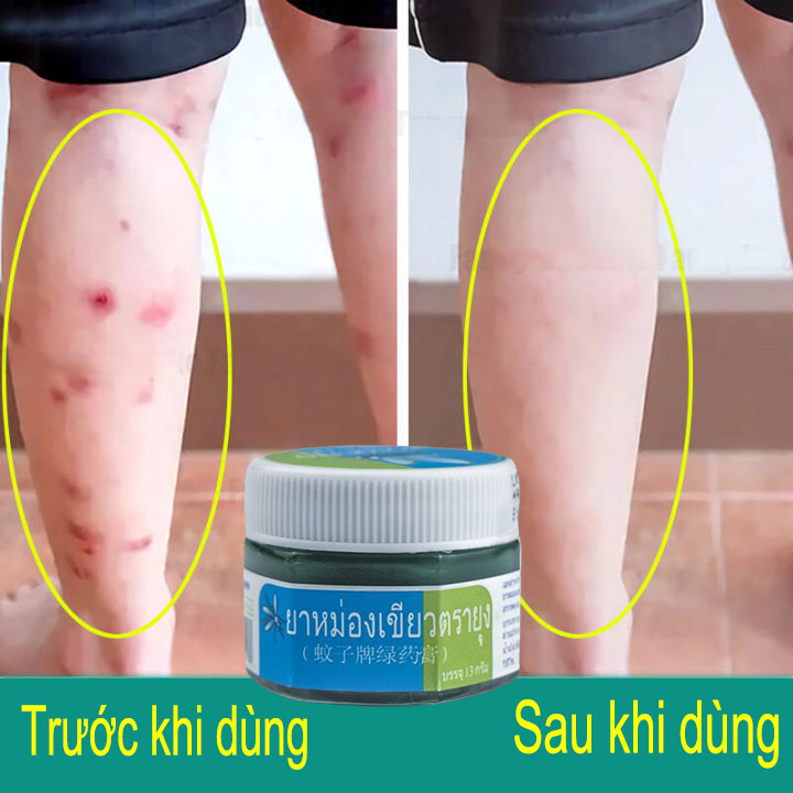 Dầu bôi vết muỗi đốt,Dầu bôi giảm muỗi đốt,Mosquito Balm Thái Lan .Chống muỗi đốt ,giảm ngứa da,ngừa vết bỏng,say tàu xe.unisex.