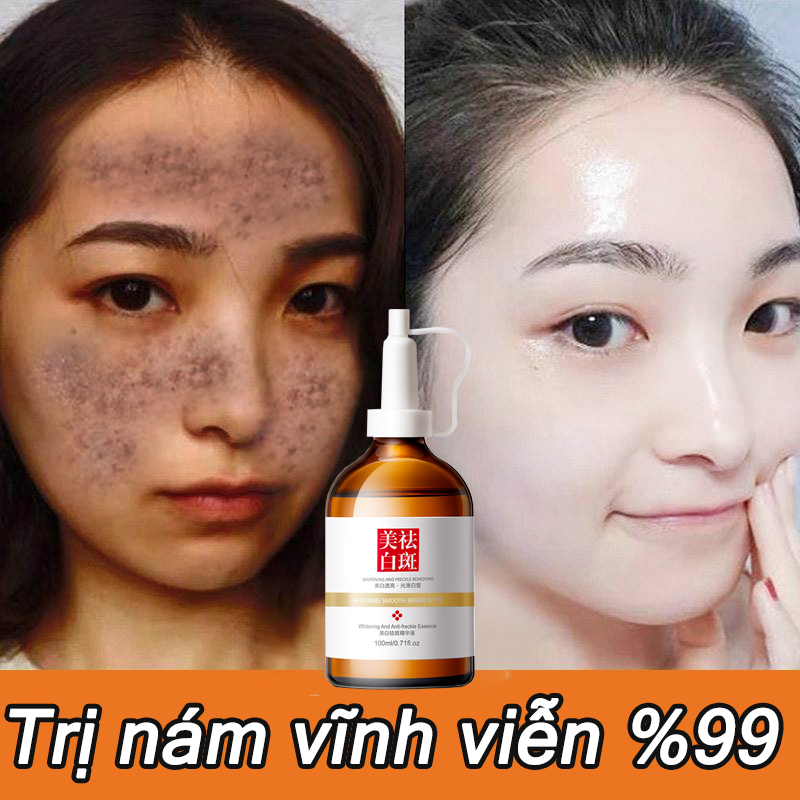 Tinh chất làm trắng sạch tàn nhang 100ml Kem trắng da và xóa tàn nhang, Hiệu quả làm mờ thâm nám tàn nhan, kem thâm nám