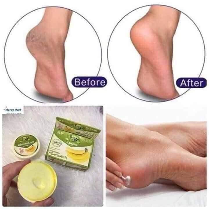 Kem nứt gót chân chuối