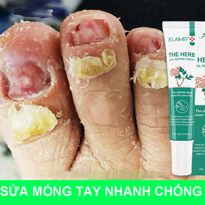 Loại bỏ nấm móng tay, móng chân, chống nấm, phục hồi móng, chăm sóc móng bị xước, đổi màu móng, móng sần sùi