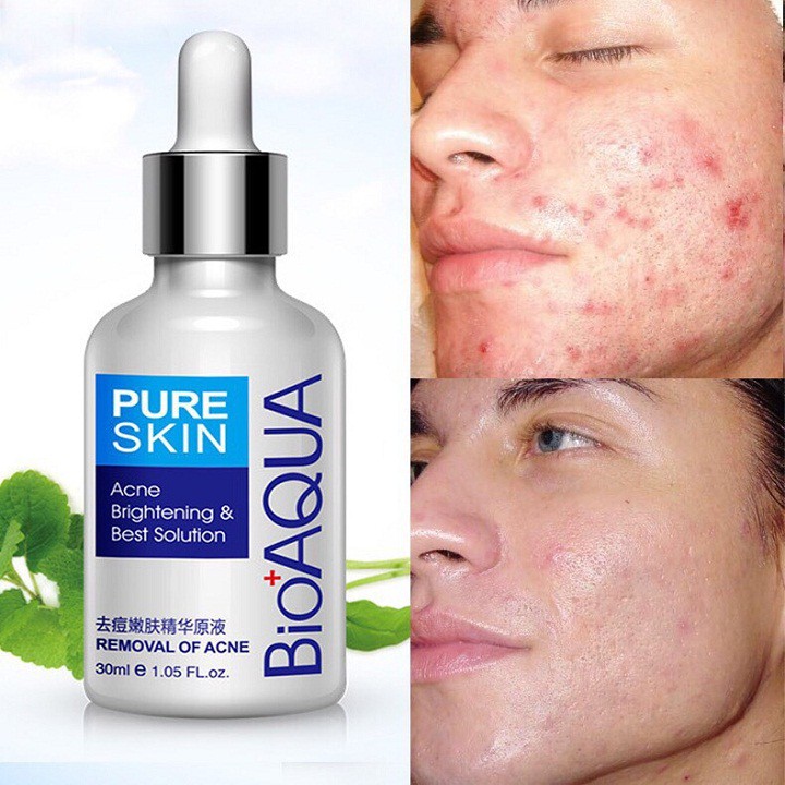 [HCM]Serum BIOAQUA Xóa mụn làm mờ sẹo và dưỡng da 30ml