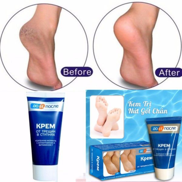 Kem dưỡng ẩm, giảm khô nứt nẻ gót chân Kpem Apteka của Nga