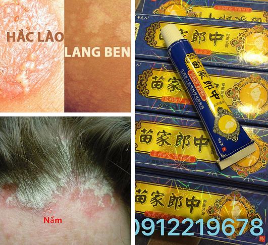 Kem bôi nấm da hắc lào lang ben tổ đỉa