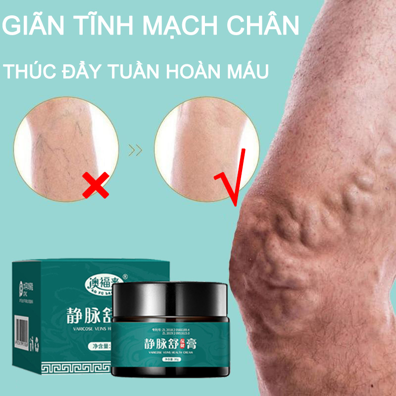 Kem gian tĩnh mạch,kem bôi suy giãn tĩnh mạch chân 30g thúc đẩy tuần hoàn máu chống suy giãn tĩnh mạch do ngồi lâu ,giãn tĩnh mạch chân