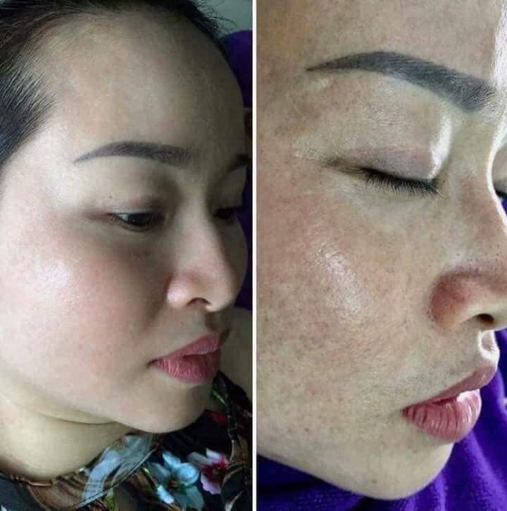 [HCM]Tái Tạo Da Hết Mụn Hết Nám Sạm Trắng Hồng
