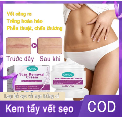 Kem trị sẹo Vết sẹo hỗ trợ trị sẹo, mờ thâm, rạn da Giảm Mụn bỏng phẫu thuật scar esthetique thuốc điều Trị