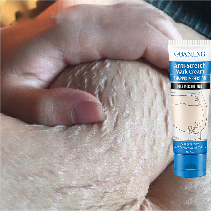 Kem xóa vết rạn da 80g Kem dưỡng làm trắng da giúp da body săn chắc giúp xoá bỏ vết rạn da , Giảm vết sẹo Kem chuyên chống rạn da cho thai kỳ Kem, dưỡng da xóa sẹo, Kem dưỡng da chống rạn ngừa sẹo