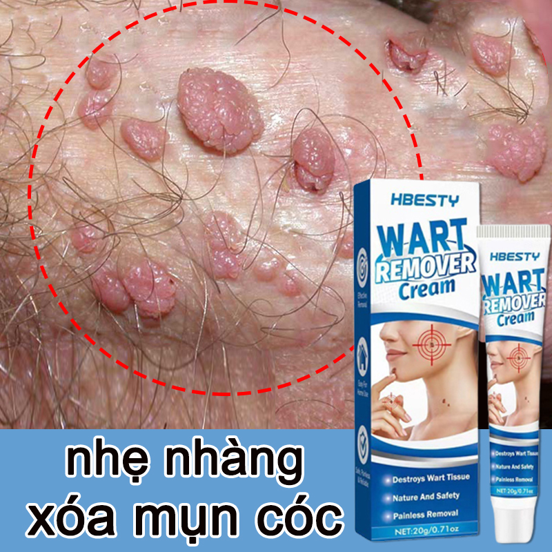 Kem xóa mụn cóc mụn cóc mụn cơm 20g gel xóa nám xóa nám xóa mụn cóc hiệu quả