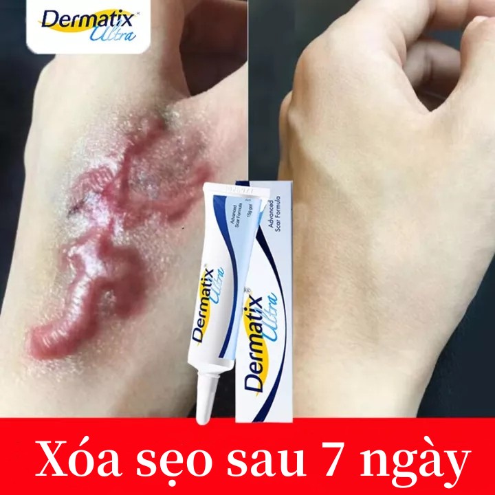 Kem bôi sẹo 15g gel mụn kem rạn da Hỗ mờ sẹo Trợ Làm Phẳng Các Vết Sẹo Lồi, Lõm thâm sẹo phì đại vết rạn da