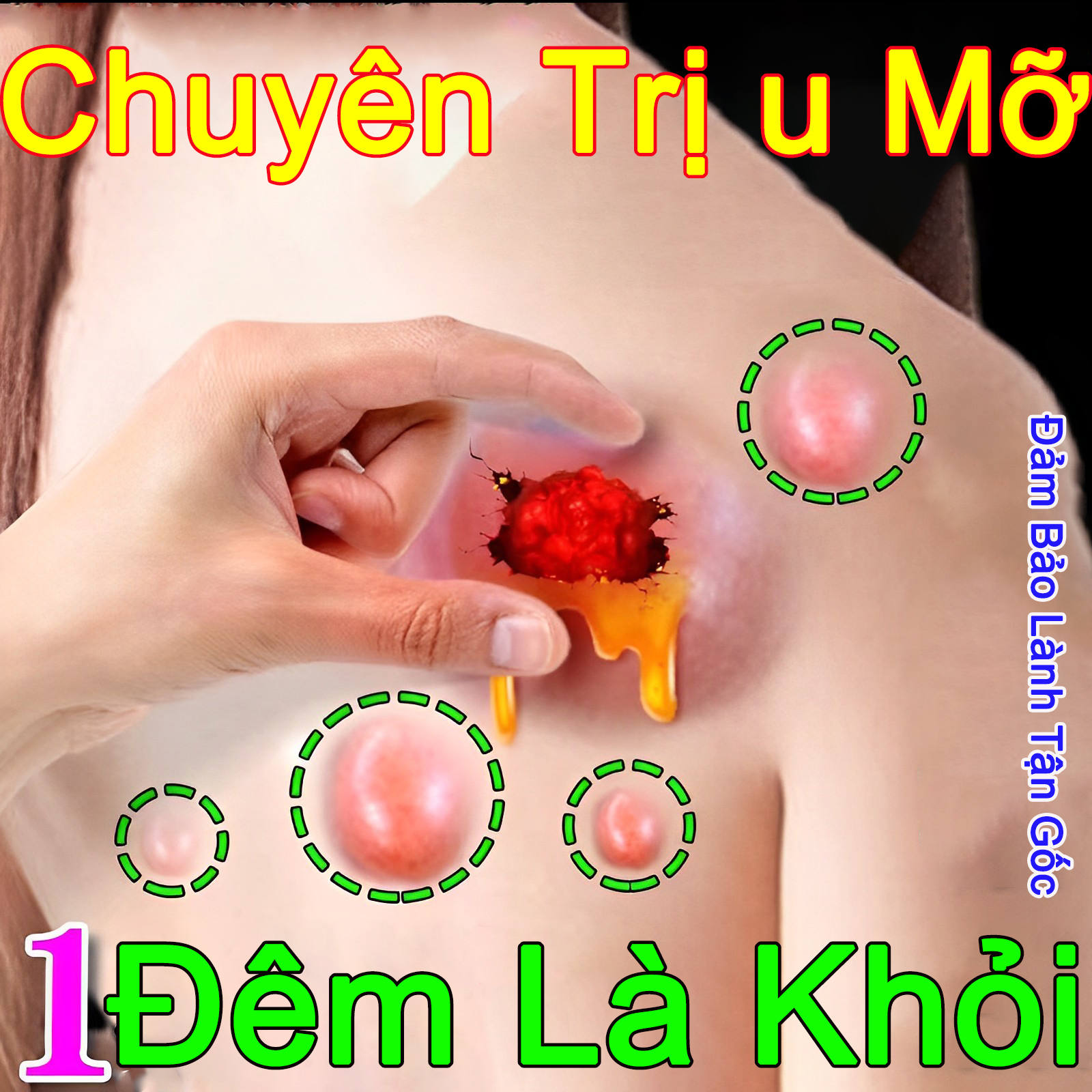 Kem loại bỏ u mỡ Kem u mỡ viêm bao gân Gel chuyên dùng loại bỏ nhiều u mỡ đơn Kem lipoma dưới da Kem phục hồi cho sưng da khối u