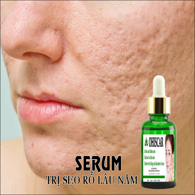 Serum xoa seo ro seo ro lau nam ohiscar