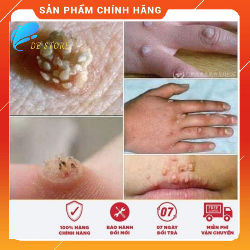 [CHÍNH HÃNG] 2H Miếng dán Ibokorori xoá mụn cóc mắt cá chân Nhật Bản DB STORE