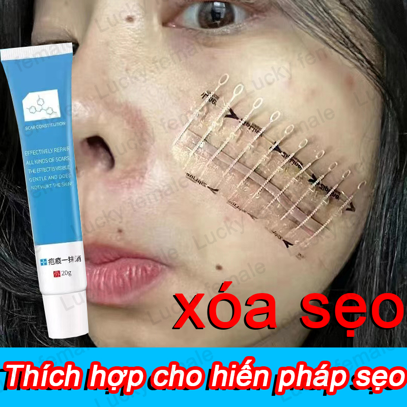 Kem mờ sẹo mờ thâm sẹo lồi sẹo lõm sẹo do mụn giúp mờ sẹo và giảm rạn da hiệu quả 20g Ngăn ngừa mụn Chống sẹo Làm mềm da Mờ sẹo thâm Sẹo lõm Trị sẹo mụn Dùng để xóa sẹo lồi Làm sáng vết thâm Ngăn ngừa mụn