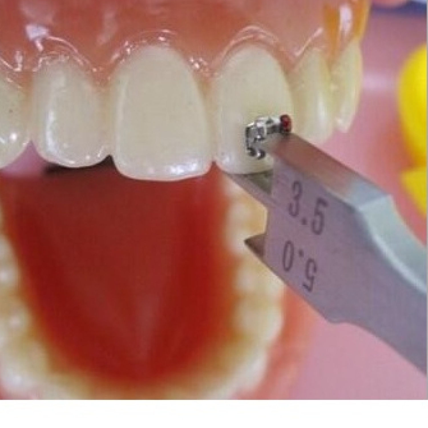 Thước đo mắc cài nha khoa,dụng cụ chỉnh nha thước đo mắc cài thép