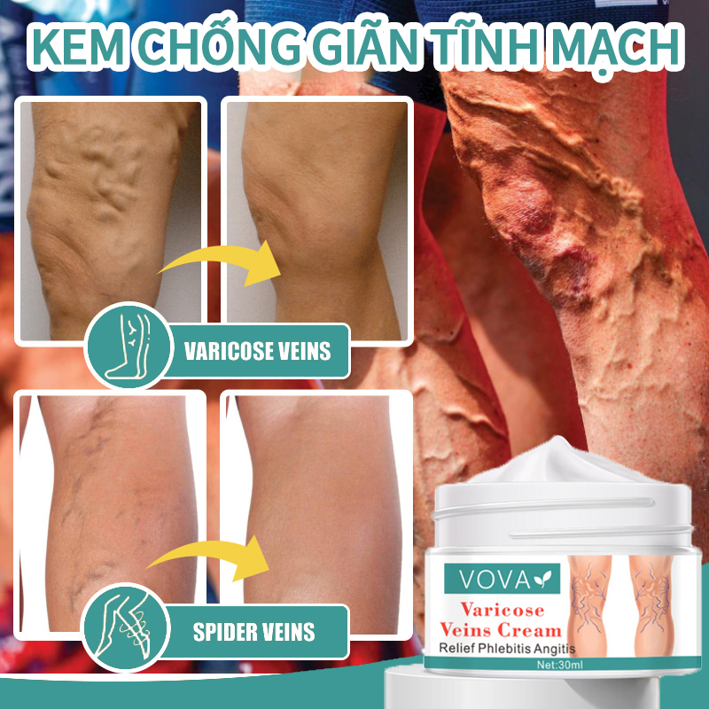 Kem Giãn Tĩnh Mạch VOVA Cải thiện Giãn tĩnh mạch, tĩnh mạch nhện, viêm, khô, tuần hoàn kém